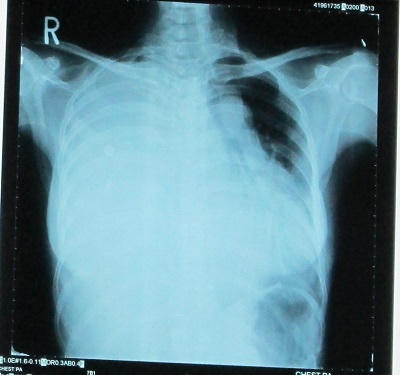 Cắt bỏ thành công khối u nặng kỉ lục 4,5kg nằm cạnh tim